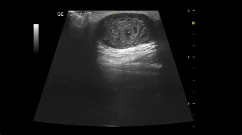 sebaceous cyst ultrasound